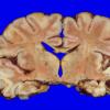 4A1 H-I gray-white reversal PTL (Case 4) 4