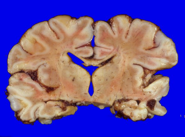 4A1 H-I gray-white reversal PTL (Case 4) 4