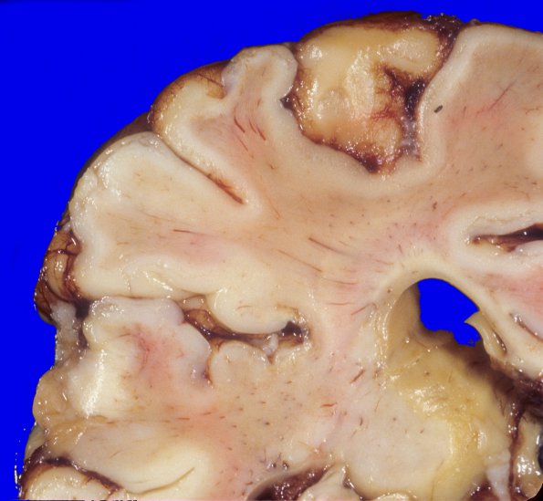 4A2 H-I gray-white reversal PTL (Case 4) 3