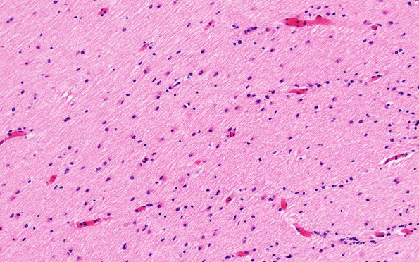 4B1 H-I gray-white reversal PTL (Case 4) N5 H&E 20X