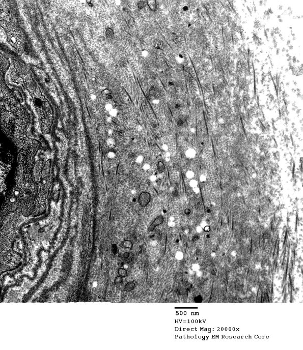 4B2 Vasculopathy (Case 4) EM 16 - Copy