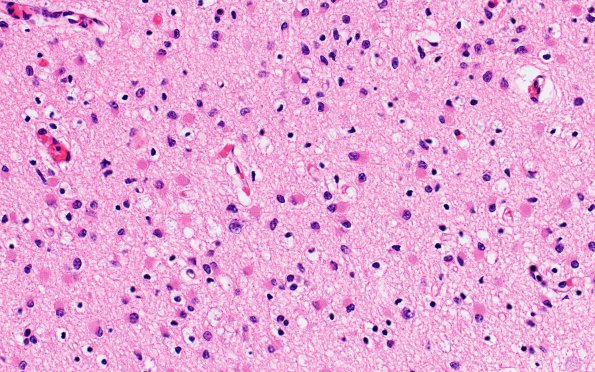 4B3 H-I gray-white reversal PTL (Case 4) N3 H&E CA1 40X 1