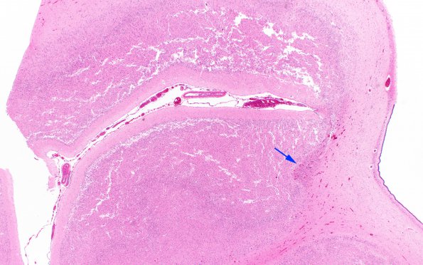 4B4 H-I gray-white reversal PTL (Case 4) N5 H&E copy