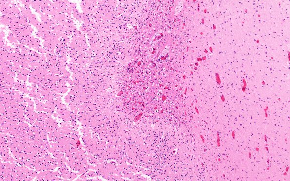 4B5 H-I gray-white reversal PTL (Case 4) N5 H&E 10X