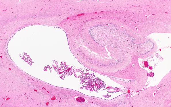 4B6 H-I gray-white reversal PTL (Case 4) N3 H&E 2X