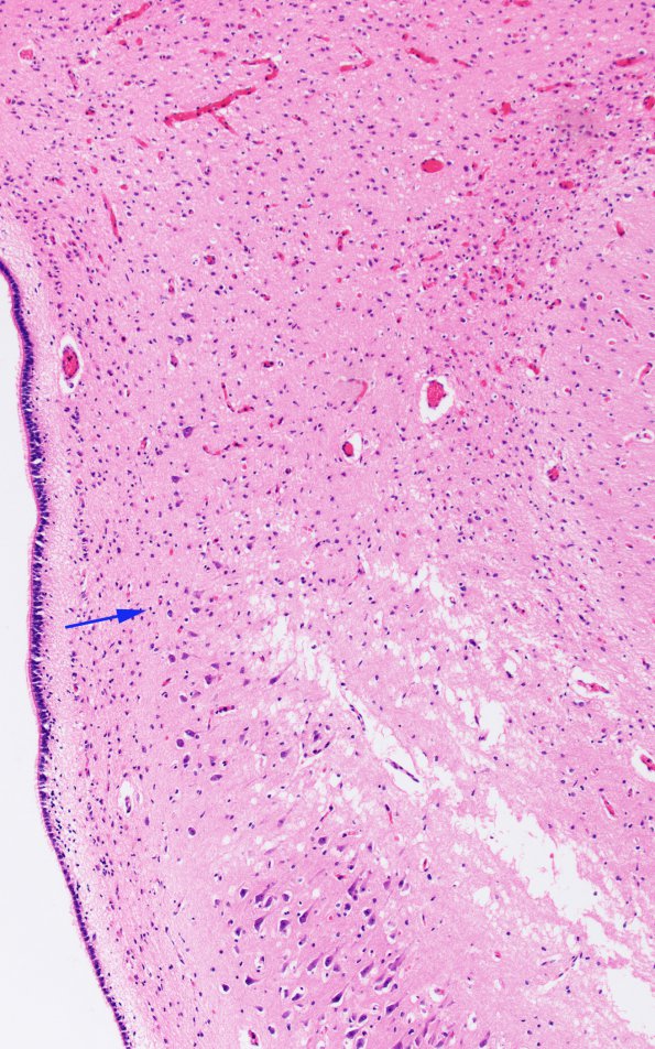 4B7 H-I gray-white reversal PTL (Case 4) N3 H&E copy