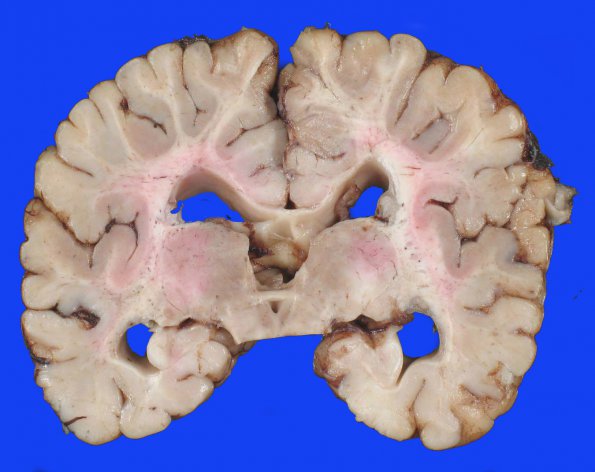 5A1 H-I, Neonatal (Case 5) 2