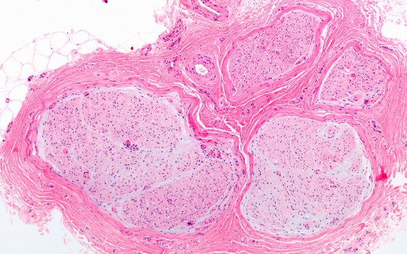 5A1 (Case 5) H&E 20X