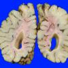 5A2 H-I, Neonatal (Case 5) 5