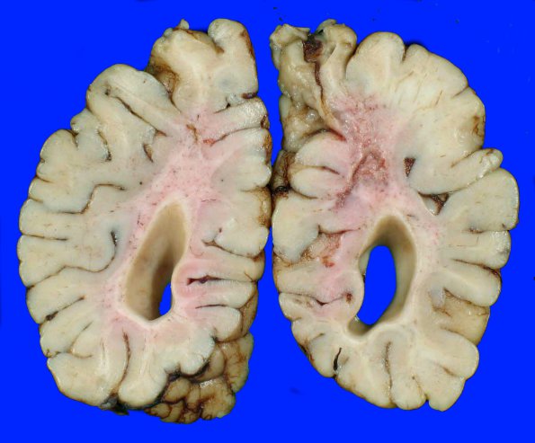 5A2 H-I, Neonatal (Case 5) 5