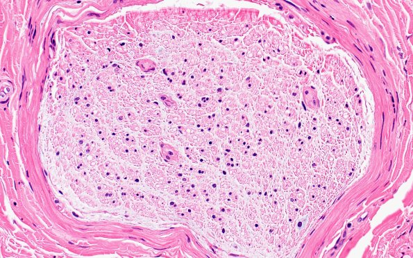 5A2 (Case 5) H&E 40X