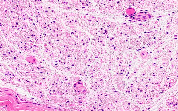 5A3 (Case 5) H&E 40X 3