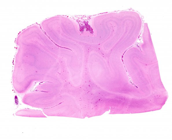 5B1 H-I, Neonatal (Case 5) H&E WM 1