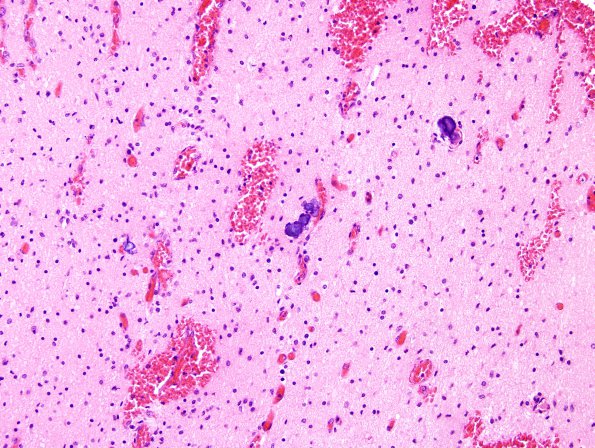 5B2 H-I, Neonatal (Case 5) White Matter H&E 2