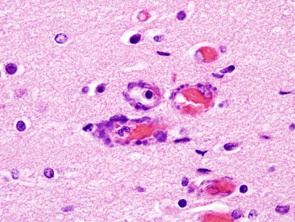 5B3 H-I, Neonatal (Case 5) White Matter H&E 1