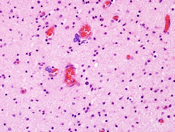 5B4 H-I, Neonatal (Case 5) White Matter H&E 4