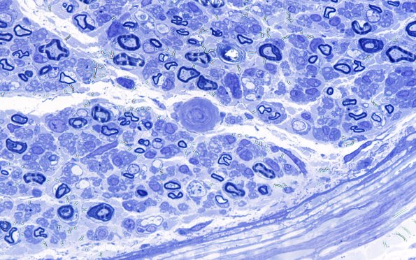 5B4 (Case 5) Plastic 100X 3