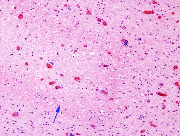 5B5 H-I, Neonatal (Case 5) White Matter H&E 6 copy