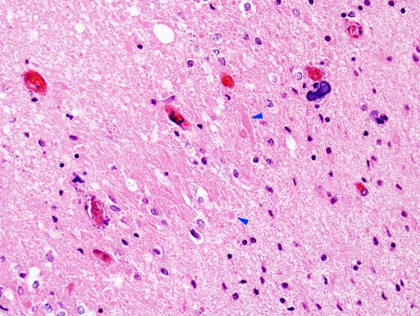 5B6 H-I, Neonatal (Case 5) White Matter H&E 5 copy