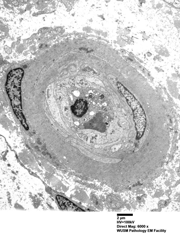 5C4 (Case 5) EM062 - Copy