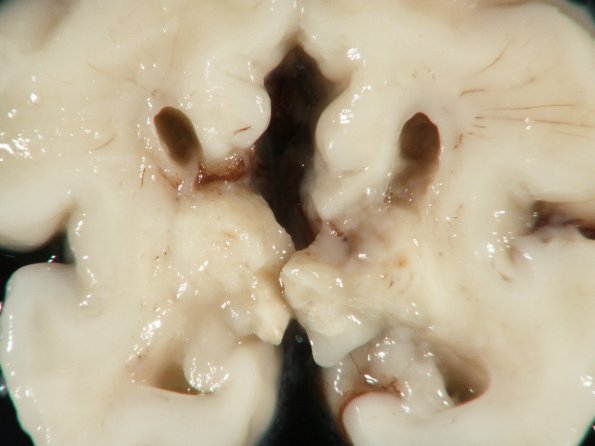 6A1 H-I, neonatal (Case 6), intrauterine Gross_4