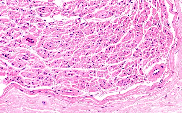 6A2 (Case 6) H&E 40X 1