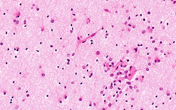 6B2 H-I, neonatal (Case 6), intrauterine H&E 3