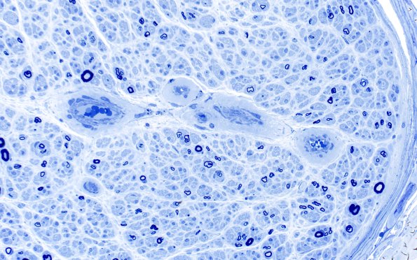 6B2  (Case 6) Plastic 40X 1