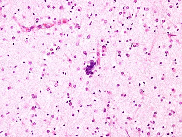 6B3 H-I, neonatal (Case 6), intrauterine H&E 1