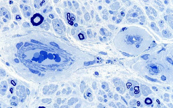 6B3 (Case 6) Plastic 100X 1