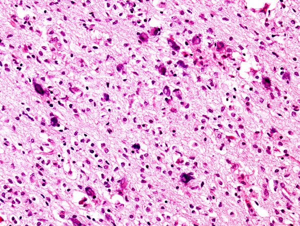 6B4 H-I, neonatal (Case 6), intrauterine H&E 2 (2)