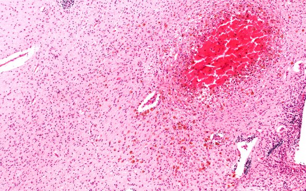 6B5 H-I, neonatal (Case 6), intrauterine H&E 2