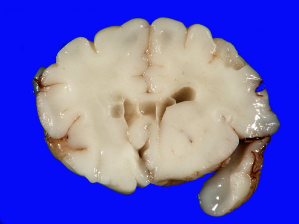 7A1 H-I, neonatal (Case 7) 2