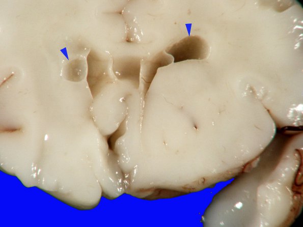 7A2 H-I, neonatal (Case 7) 1