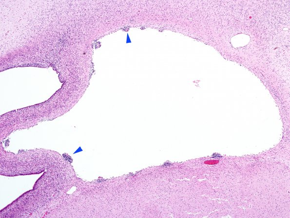 7B2 H-I, neonatal (Case 7) N13 H&E 1 copy