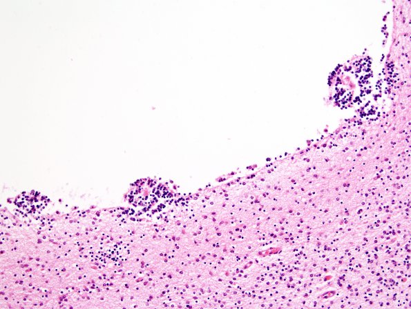 7B3 H-I, neonatal (Case 7) N13 H&E 2