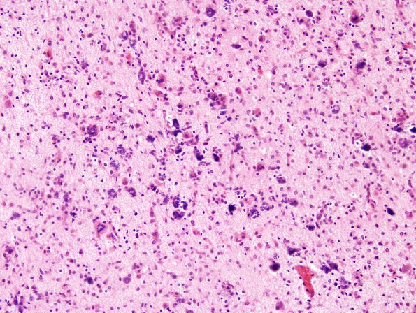 7B4 H-I, neonatal (Case 7) BG H&E