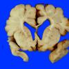 8A1 Hypoxia Ischemia, neonatal (Case 8) 2