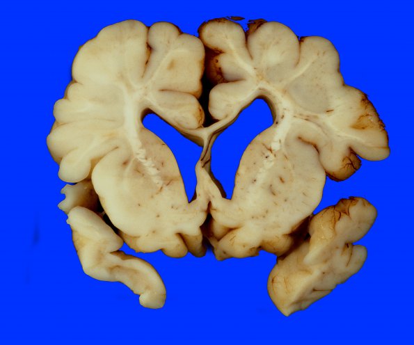 8A1 Hypoxia Ischemia, neonatal (Case 8) 2