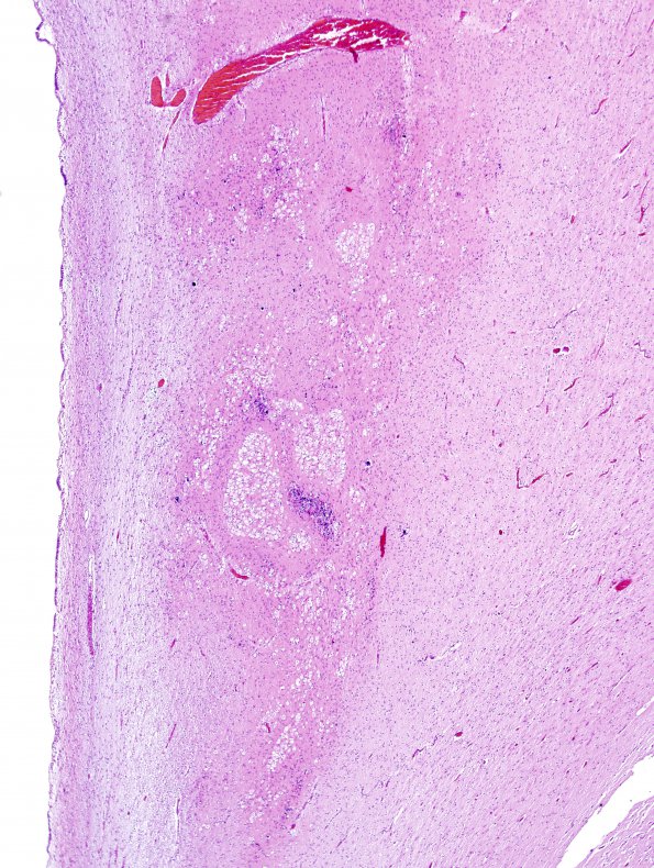 8B2 Hypoxia Ischemia, neonatal (Case 8) 5