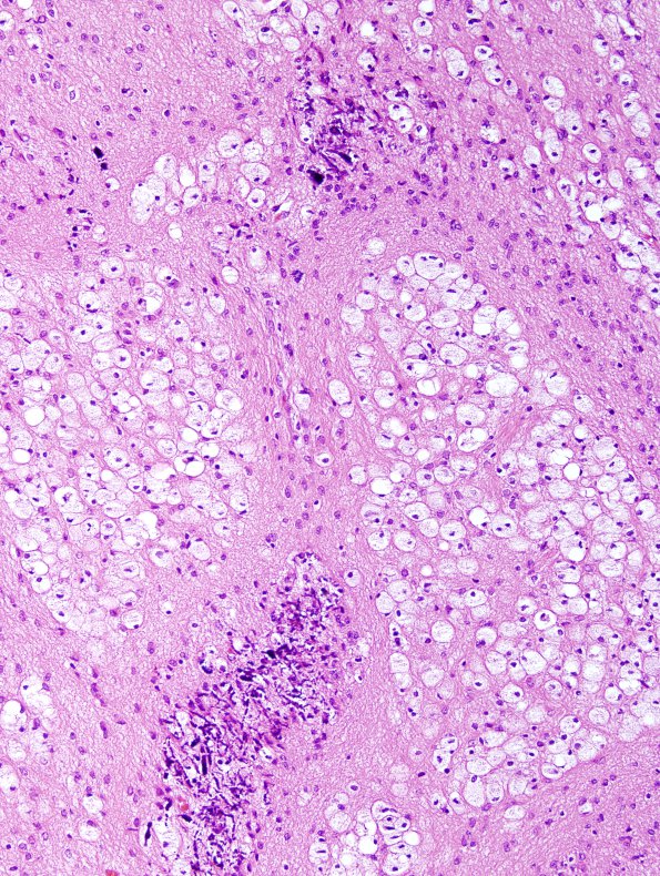 8B3 Hypoxia Ischemia, neonatal (Case 8) 6