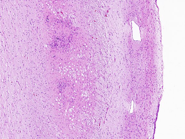 8B4 Hypoxia Ischemia, neonatal (Case 8) 4