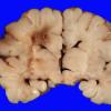 9A1 H-I, neonatal (Case 9) 5