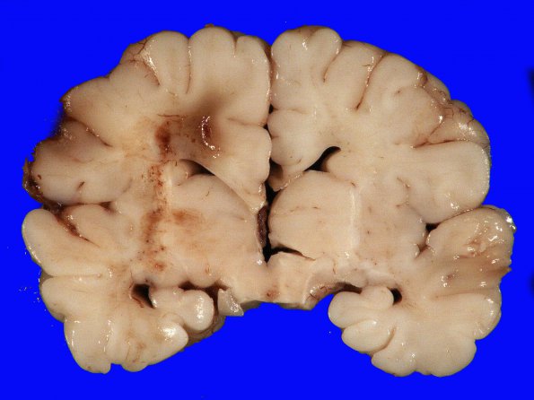 9A1 H-I, neonatal (Case 9) 5