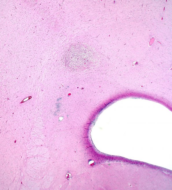 9B2 H-I, neonatal (Case 9) H&E 4