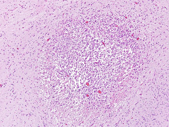 9B3 H-I, neonatal (Case 9) H&E 3