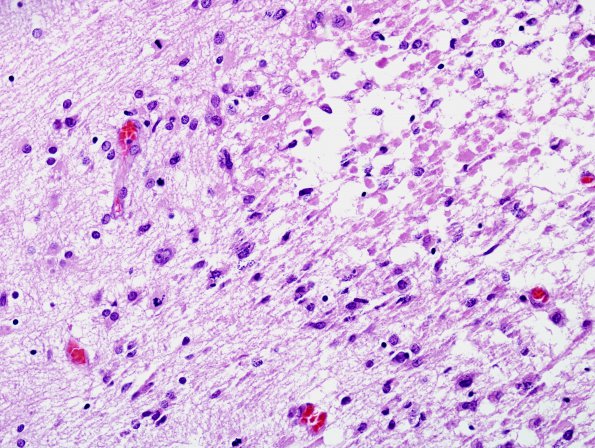 9B4 H-I, neonatal (Case 9) H&E N12 1