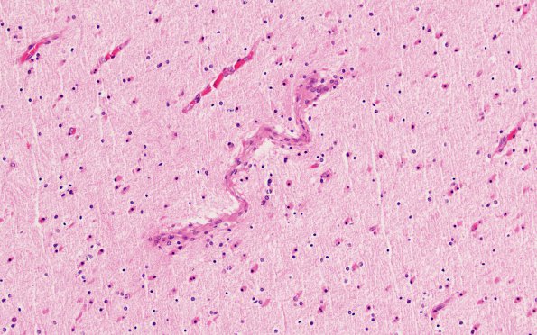 9B5 H-I, neonatal (Case 9) H&E 20X