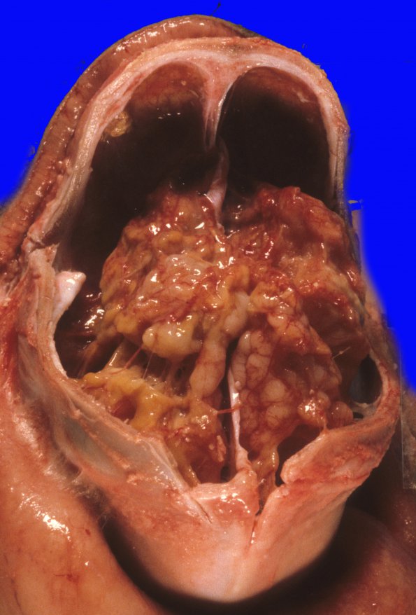 1A1 Multicystic Encephalopathy (Case 1) 1a