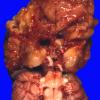 1A2 Multicystic encephalopathy (Case 1) 2